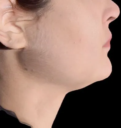 Antes y después Accutite de InMode