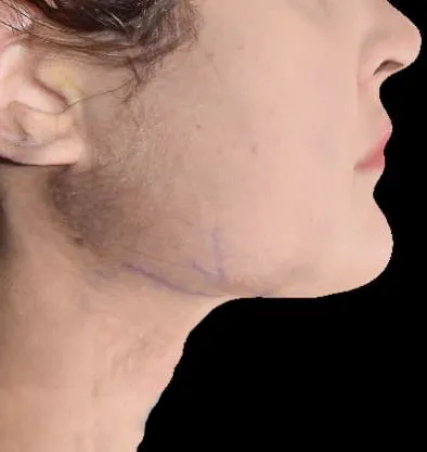 Antes y después Accutite de InMode