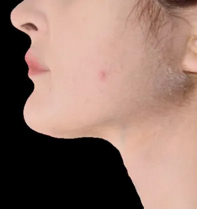 Antes y después Accutite de InMode