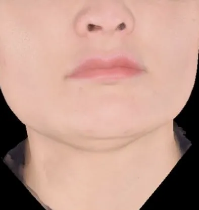 Antes y después Accutite de InMode