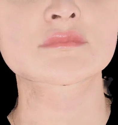 Antes y después Accutite de InMode