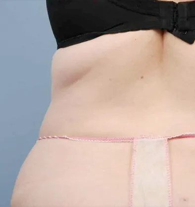 Antes y después Bodytite InMode