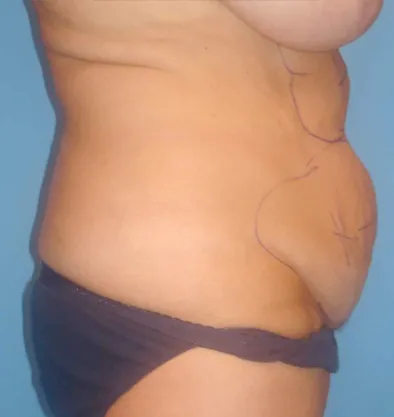 Antes y después Bodytite InMode