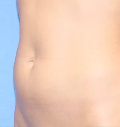 Antes y después Facetite InMode