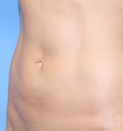 Antes y después Facetite InMode