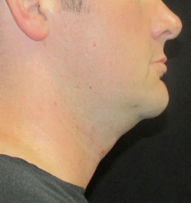 Antes y después Facetite InMode