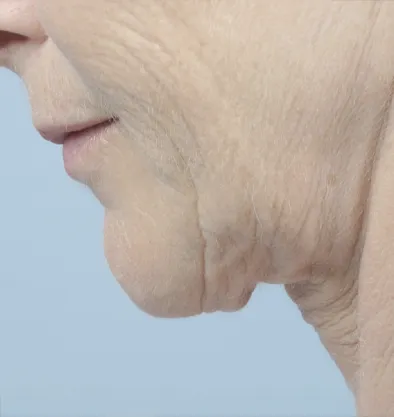 Antes y después Facetite InMode