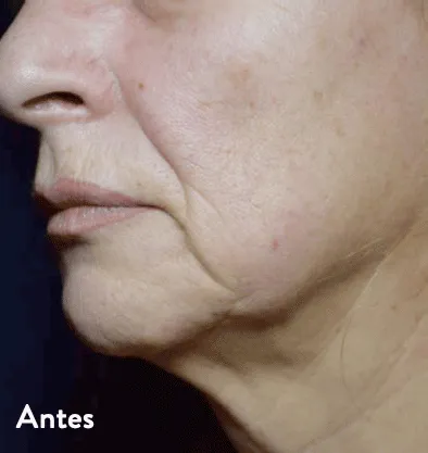 Antes y después Embrace RF InMode