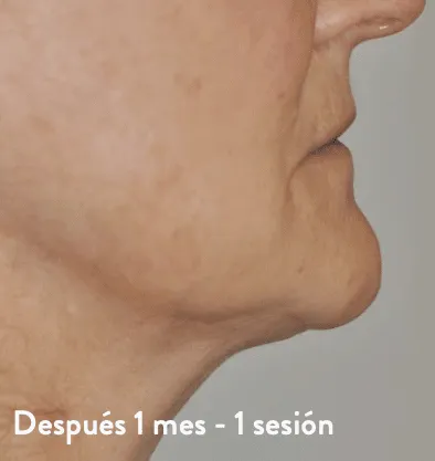 Antes y después Embrace RF InMode