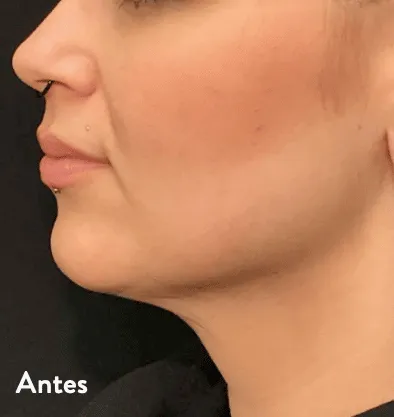 Antes y después Embrace RF InMode