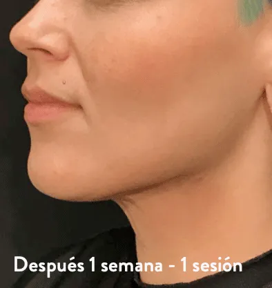 Antes y después Embrace RF InMode