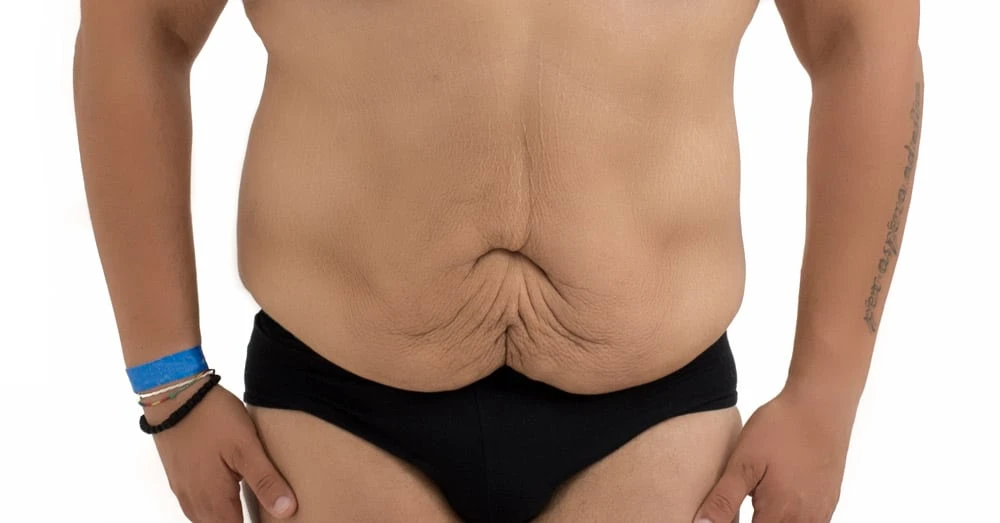 Lipectomia de cinturón