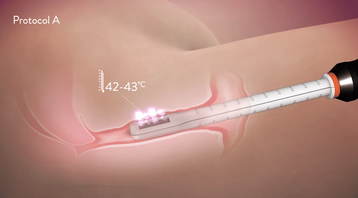 Protocolo A Forma V de Inmode