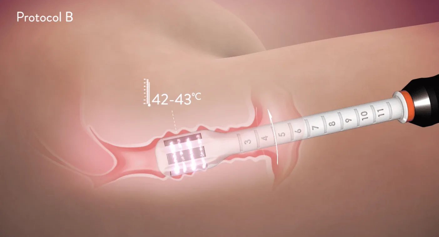 Protocolo B Forma V de Inmode