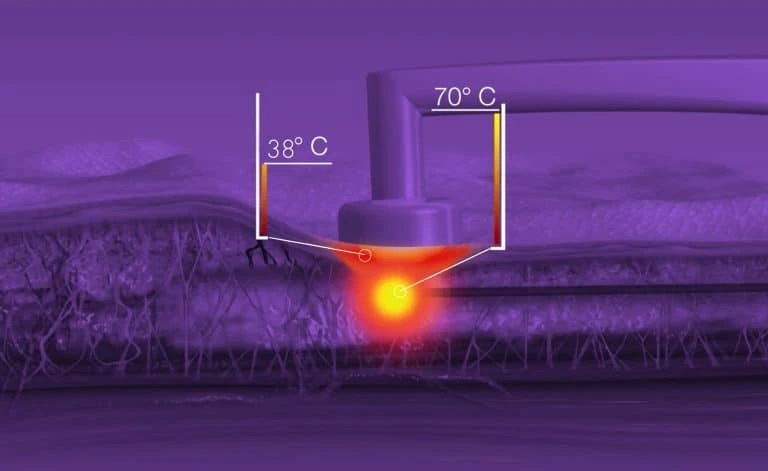 Tecnología bodytite de inmode